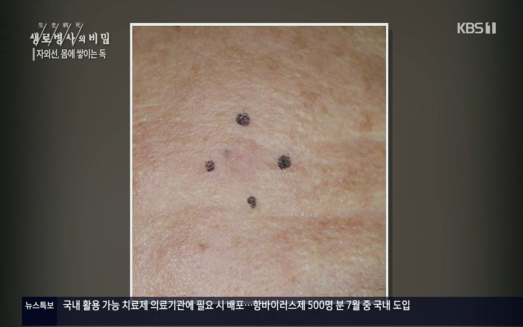 생로병사의 비밀.E824.220629p.H264-F1RST.mp4_20220630_205904.073.jpg