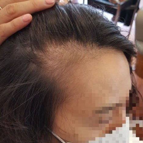  탈모 초기 증상과 종류 해야 하는 5가지 행동들 알아보자 탈모 초기 증상과 종류 해야 하는 5가지 행동들 알아보자 탈모 초기 증상과 종류 해야 하는 5가지 행동들 알아보자 탈모 초기 증상과 ..