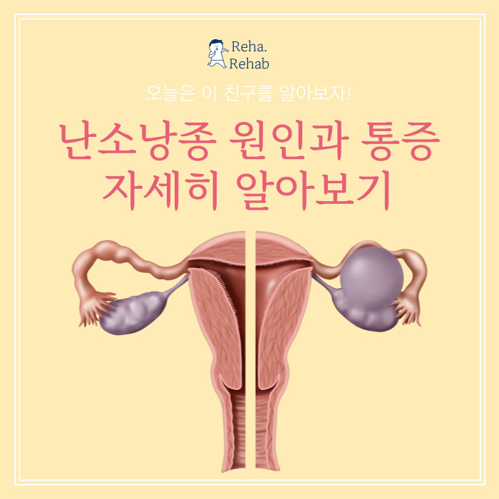 난소낭종 원인과 통증에 대해 자세히 알아보기 (Ovaryan cyst)