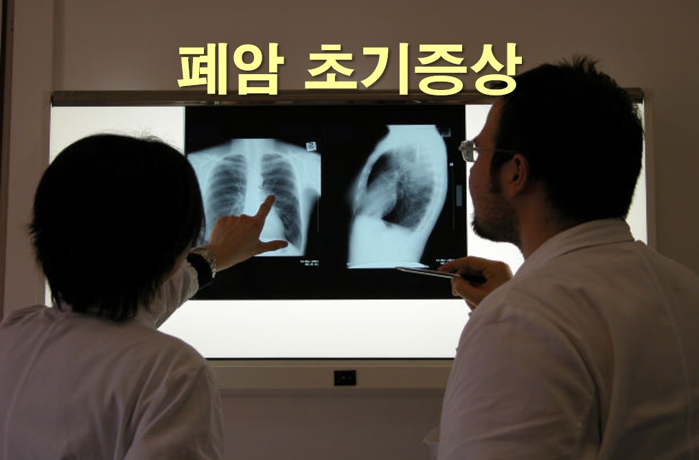  폐암의 초기증상으로 잦은 기침에 대해서