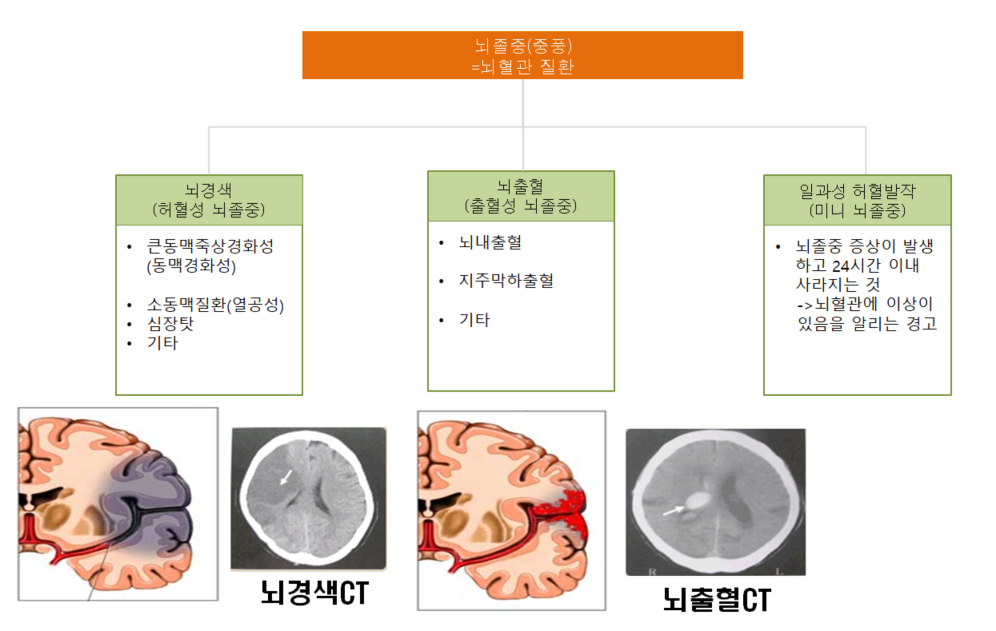 뇌졸중 사진