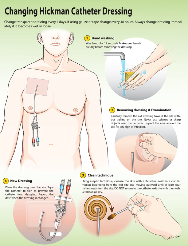 hickman catheter removal