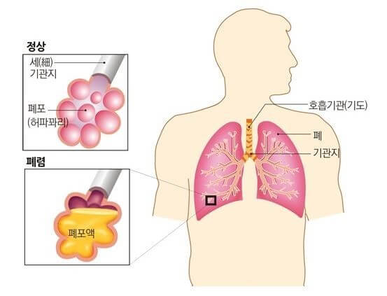 폐렴의 형태