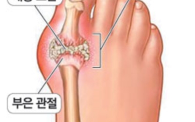 통풍이미지