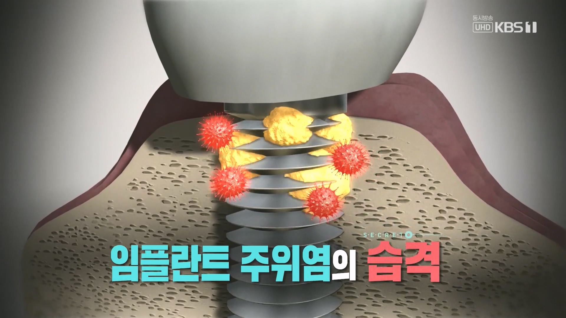 생로병사의 비밀.E890.231213p.H264-F1RST.mp4_20231214_195024.855.jpg