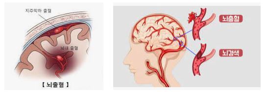 뇌출혈 - 뇌경색