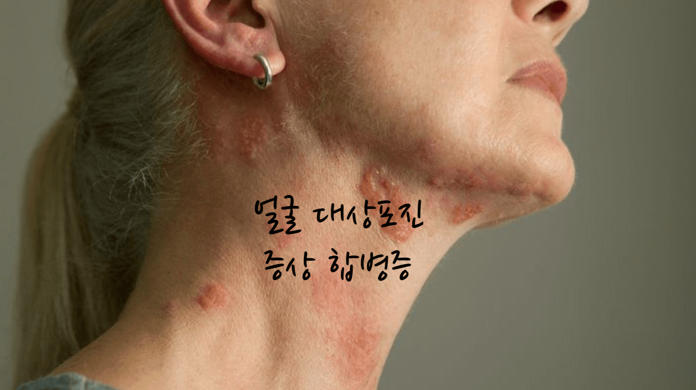 얼굴 대상포진