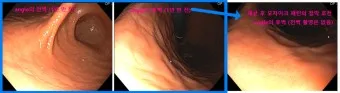 헬리코박터균 제균 치료 치료방법 성공률_13
