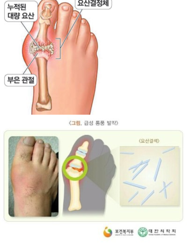  발등이 부어올라 아파요 .통풍의 원인과 예방법