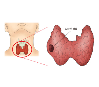 갑상선