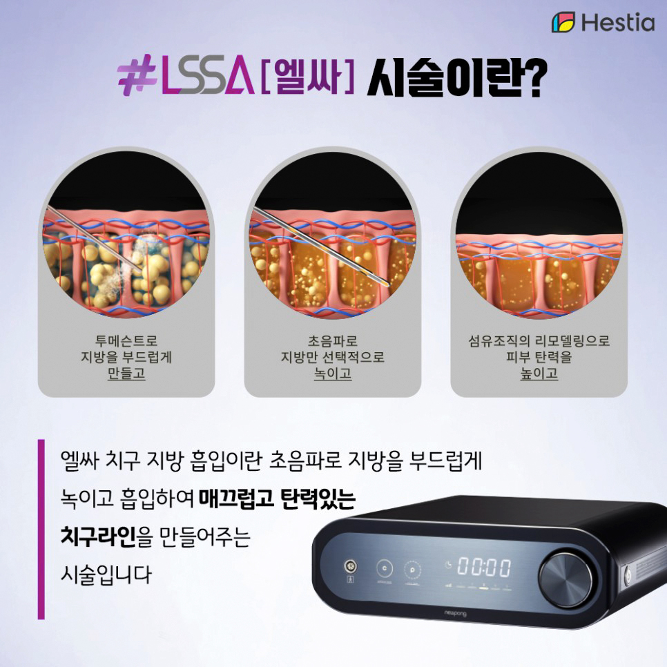 Y존살 빼는 방법 운동으로 효과없다면 엘싸 치구성형