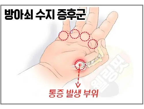 손가락-방아쇠-수지-증후군-통증-부위