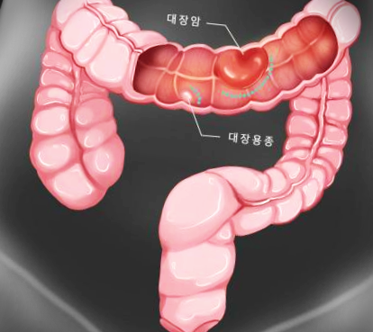  대장암 원인과 예방법 정리