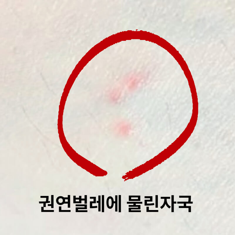권연벌레 물린자국 증상과 치료, 퇴치방법은? 권연벌레 물린자국 증상과 치료, 퇴치방법은?
