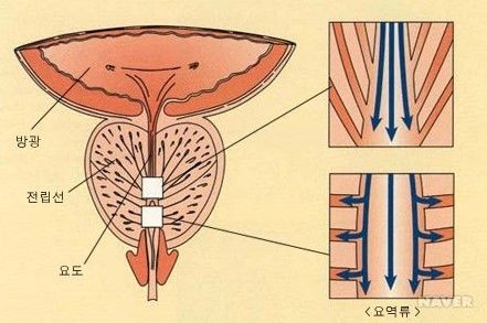 전립선비대증 치료