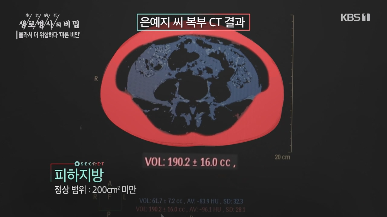 생로병사의 비밀.E889.231109p-NEXT.mp4_20231109_203826.232.jpg