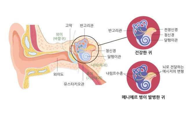 메니에르병 증상