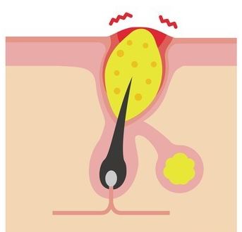  얼굴 여드름! 제대로 알고 깔끔하게 없애자! (비립종 피지낭종 모낭염)