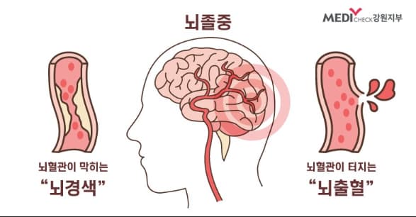 뇌졸중-뇌경색-뇌출혈