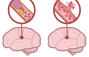 뇌졸중 혈관