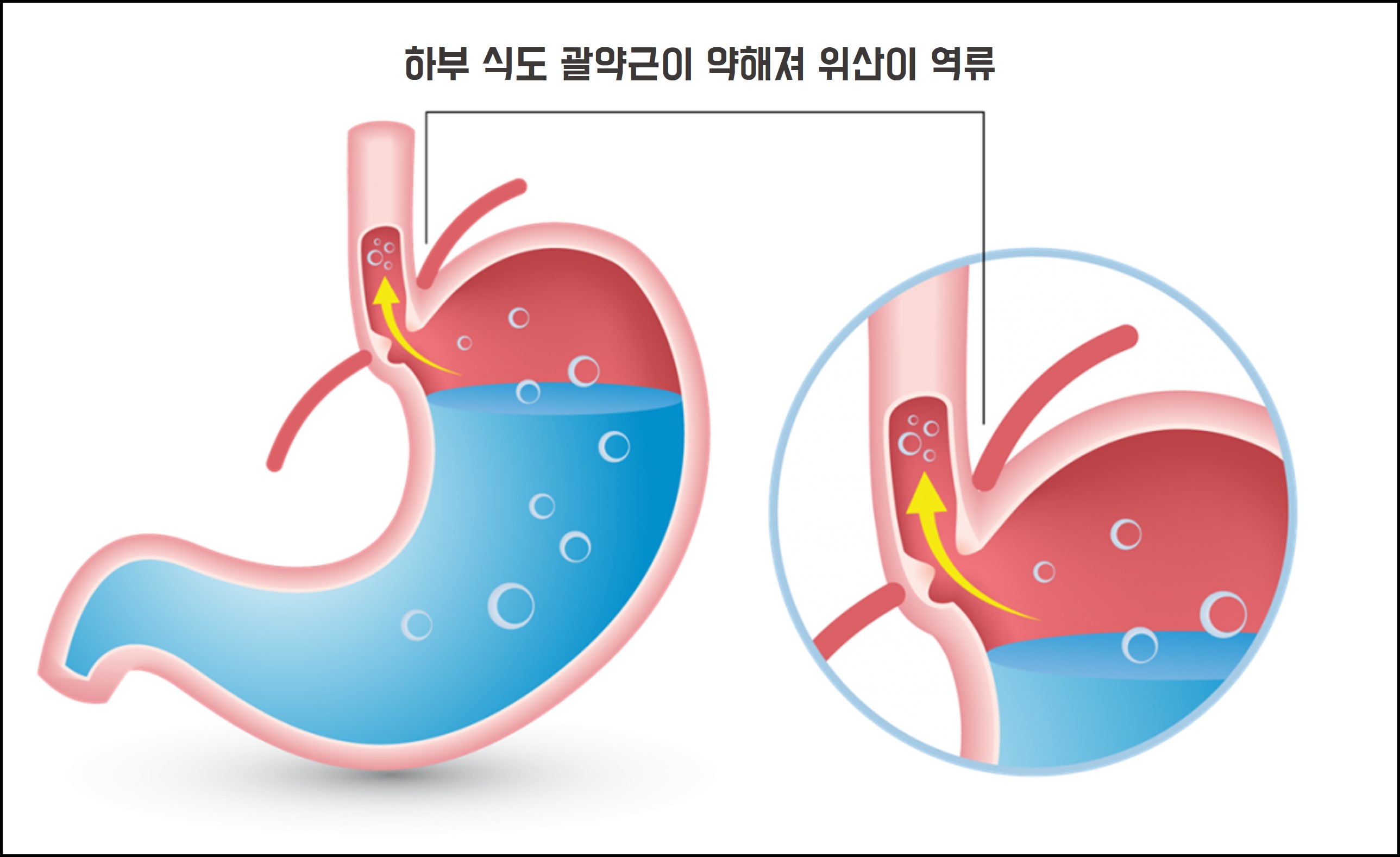 역류성 식도염 원인이 생기는 원인