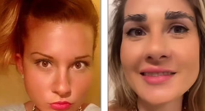 자신의 머리 털로 눈썹 이식한 10대...어머! 숯덩이네! VIDEO:Cotswolds woman undergoes eyebrow transplant using hairs from head