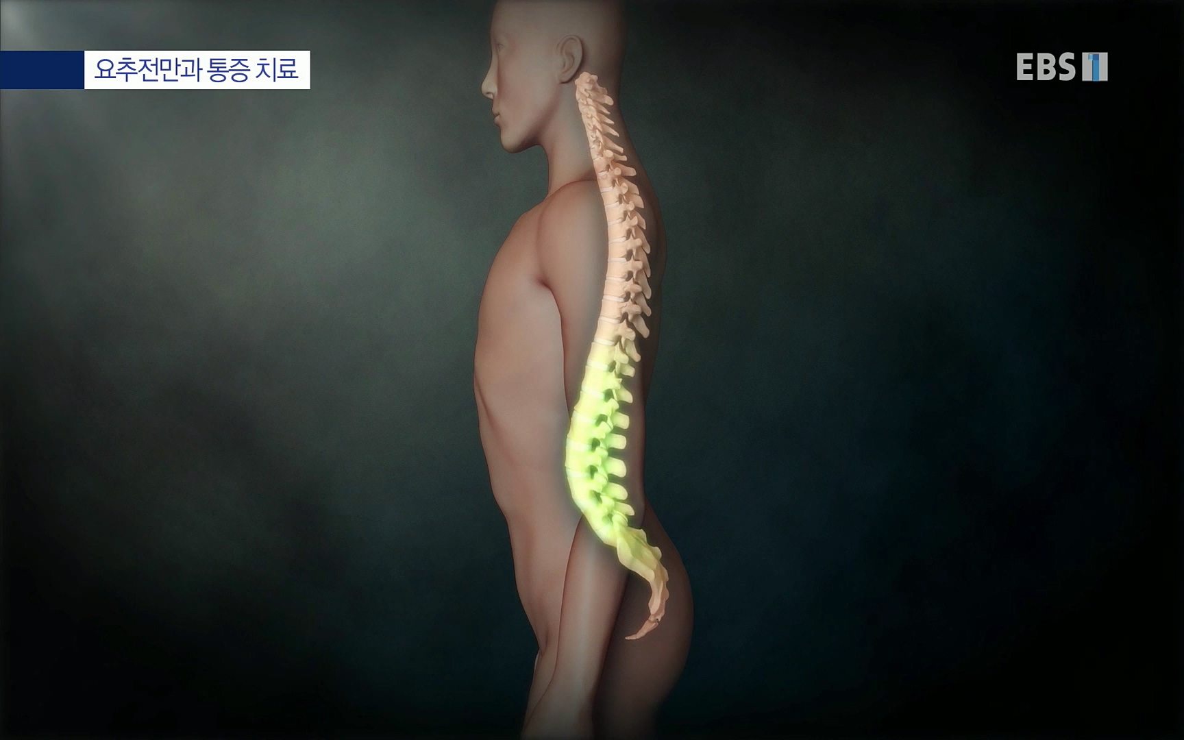 EBS 명의 헬스케어 - TV - 교육의 중심 EBS허리 통증 치료 프로젝트 1부, 수술없이 낫는다 .mp4_20220712_204020.529.jpg