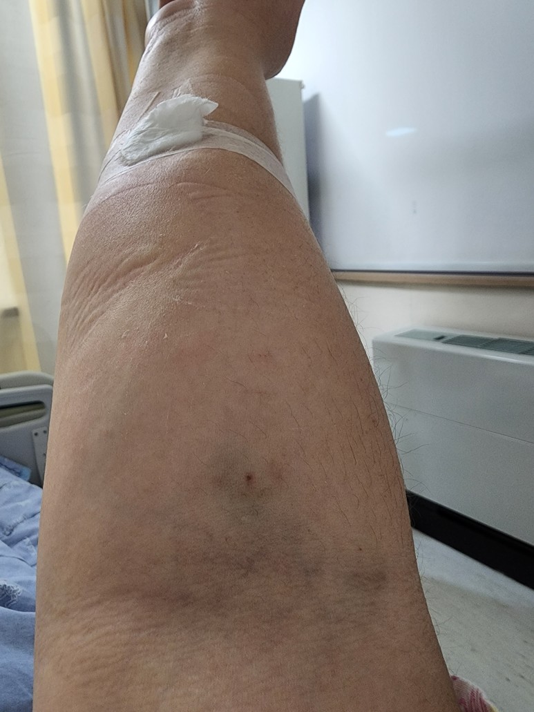 담관결석으로 ERCP 시술 FEAT 고대안암병원 (임신부담낭염) <임신 32주차 임산부> 임산부담석증,