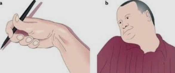  근육 긴장 이상증  알아보자