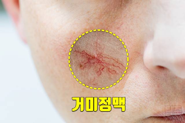 얼굴 붉은기 원인 얼굴 빨개지는 이유 얼굴홍조 원인 모세혈관확장증 거미정맥