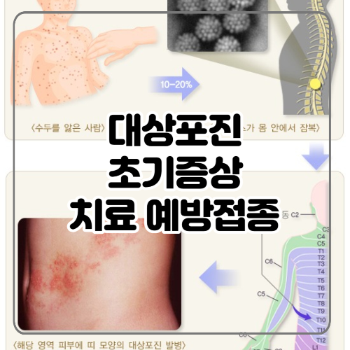 대상포진 초기증상 치료 예방접종 정보