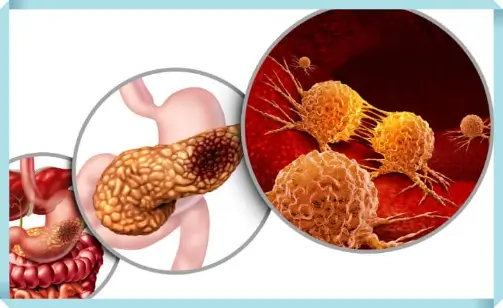암으로 전이된 췌장암