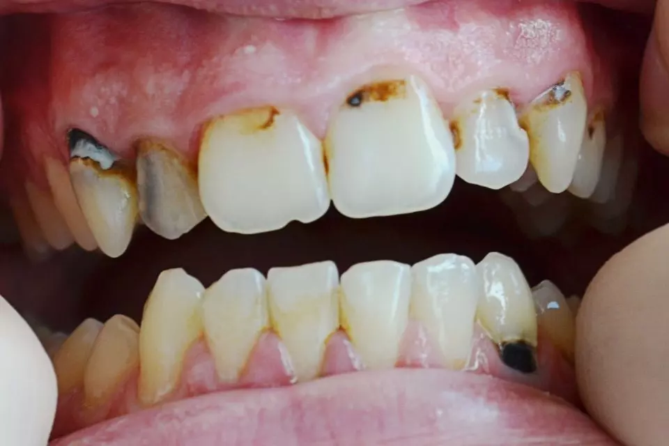치주염(Periodontitis)