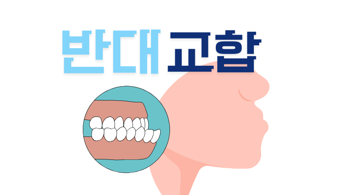 반대 교합 교정 비용 및 후기