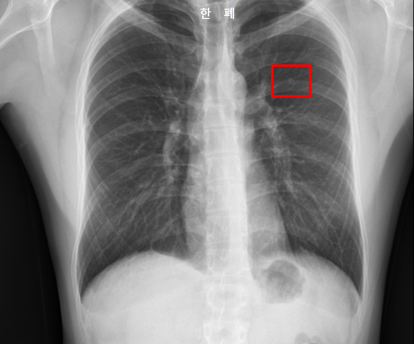 폐결절 커짐 X-ray 사진