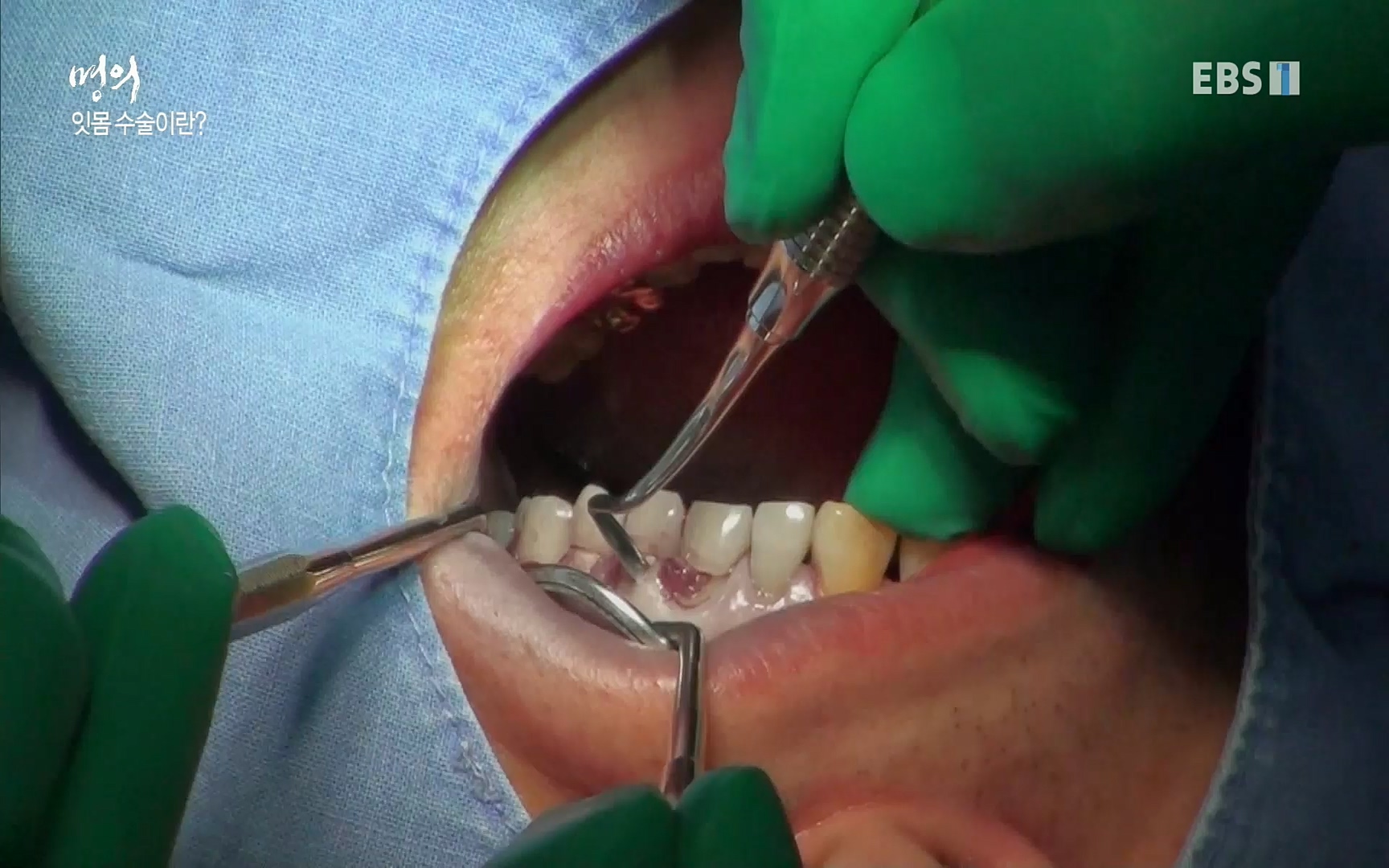 EBS 명의 헬스케어 - TV - 교육의 중심 EBS치주염이 코로나로 소홀해진 구강관리가 치아를 더 망가트리고 위험하게 만들며, 증상이 없기 때문에 특히 더 조심하고 치은염 단계에서 진행되지 않도록 예방해야한다 정의원 교수님과 치_20220505_151726.274.jpg