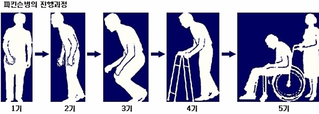  손떨림 증상 파킨슨병 초기 증상 및 원인, 치료 예방법 입니다.