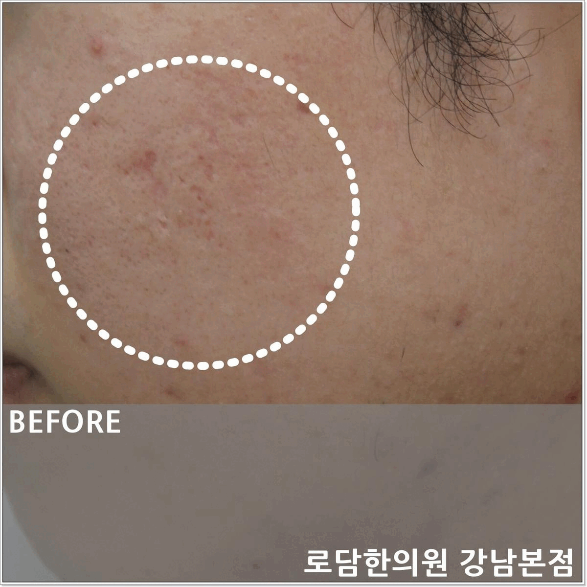  여드름 패인흉터 제거 한의원에서는 어떻게 치료할까?