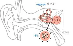 이석증 증상