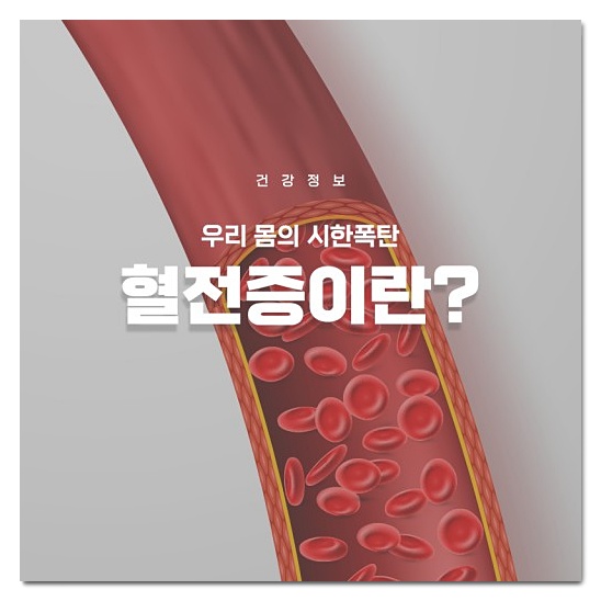  아스트라제네카 얀센 혈전 증상