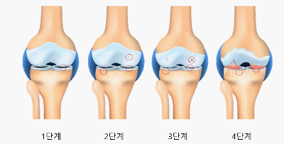 무릎 관절염 진행 속도 