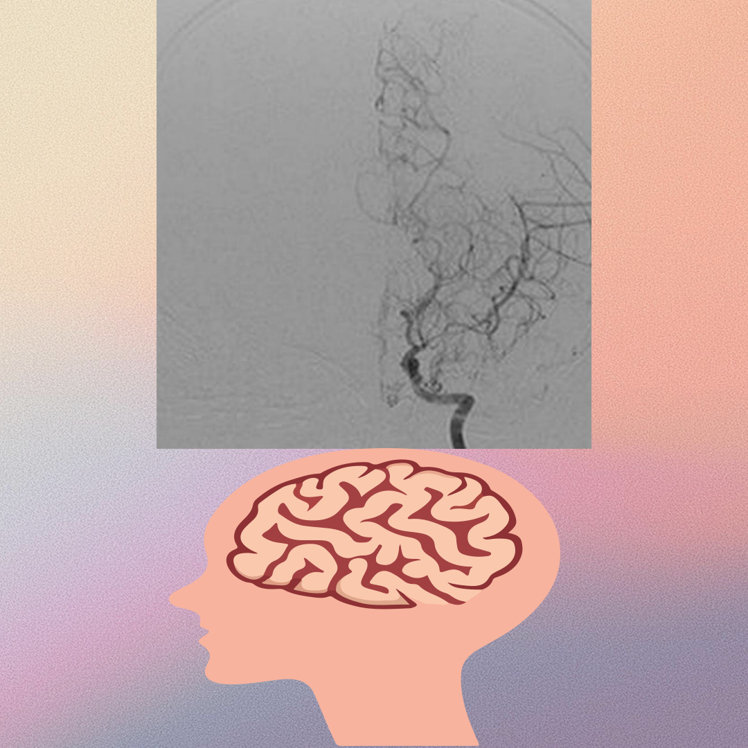 모야모야병 사진