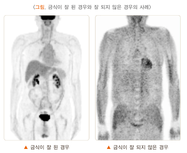 PET CT 검사