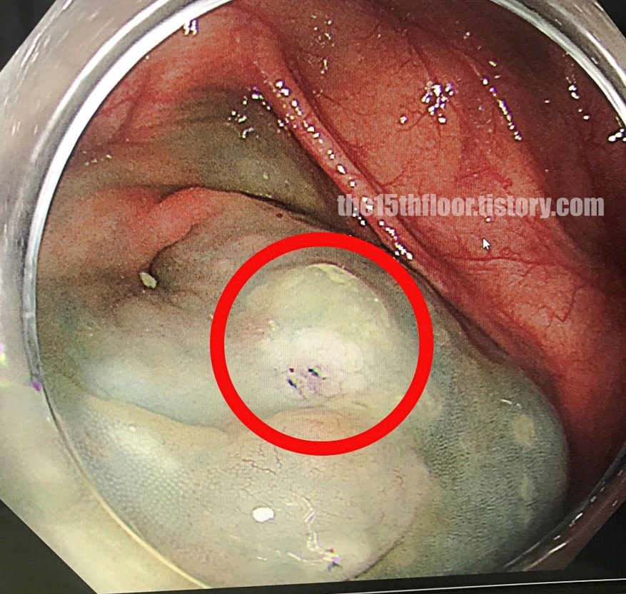 대장 용종 (2)