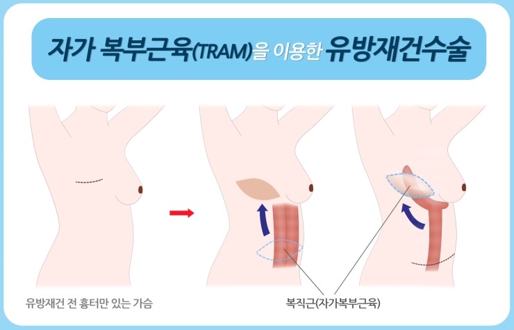 유방 이미지