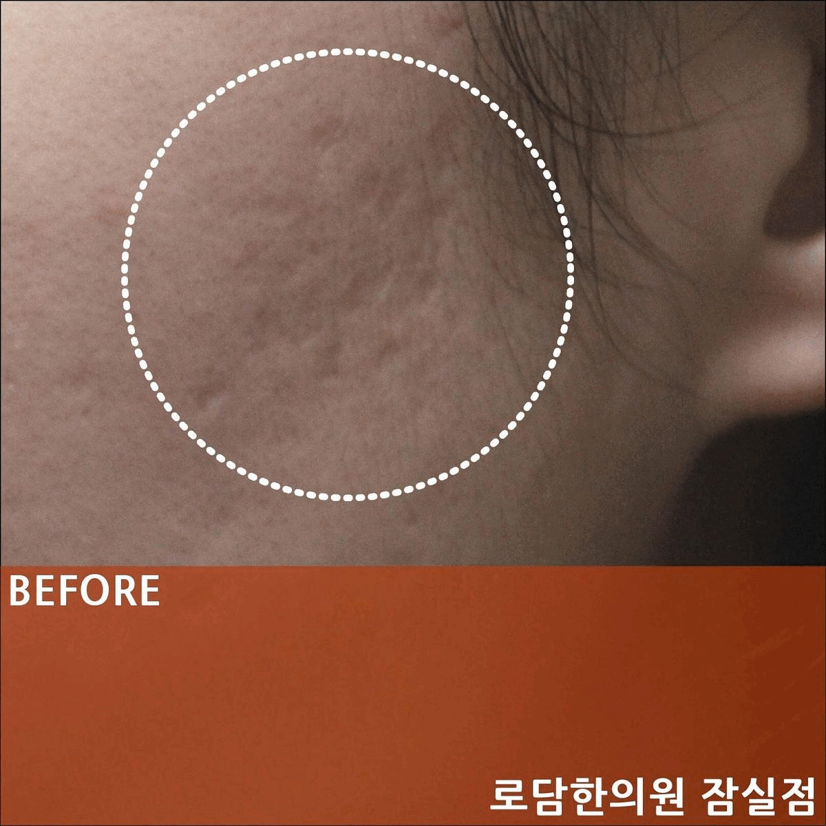  잠실 여드름 흉터 라운드형 치료 과정 한의원 새살침 코라테라피
