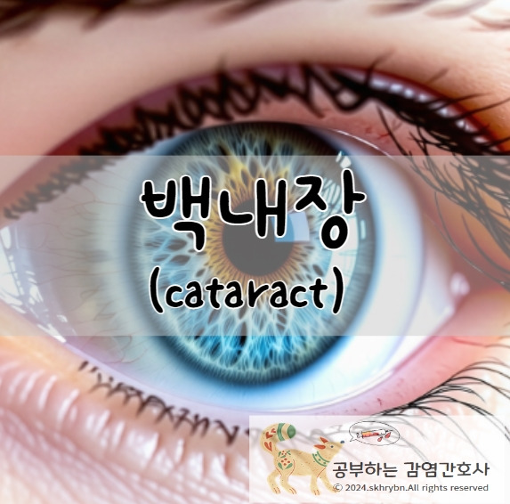 백내장(cataract)