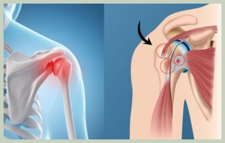 어깨충돌 증후군 이란?