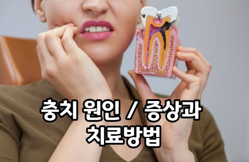 충치 원인 증상 및 치료방법