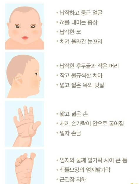  유전질환 다운증후군이란??유전적 장애  다운증훈군의 모든 것 !!